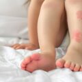 Alergia niemowlę objawy czy zawsze są widoczne?