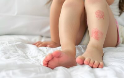 Alergia niemowlę objawy czy zawsze są widoczne?